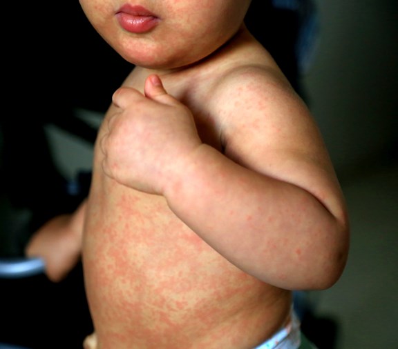 baby with measles that did not get an mmr vaccine